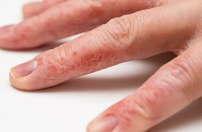 Viêm da cơ địa - Cơ chế “ngứa – gãi – nặng hơn” Viêm da cơ địa - Cơ chế “ngứa – gãi – nặng hơn”