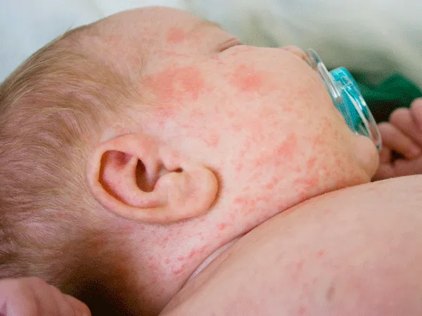 Viêm da cơ địa - Yếu tố di truyền và cơ địa dị ứng Viêm da cơ địa - Yếu tố di truyền và cơ địa dị ứng